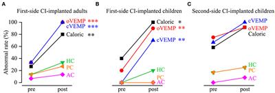 Vestibular Function in Children and Adults Before and After Unilateral or Sequential Bilateral Cochlear Implantation